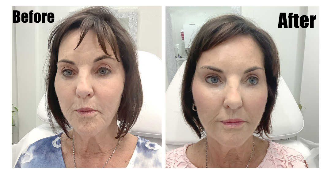 After Treatment