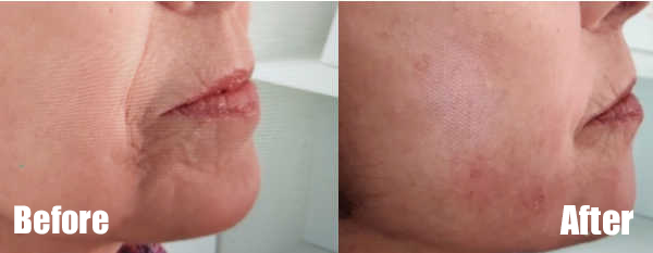 After Treatment