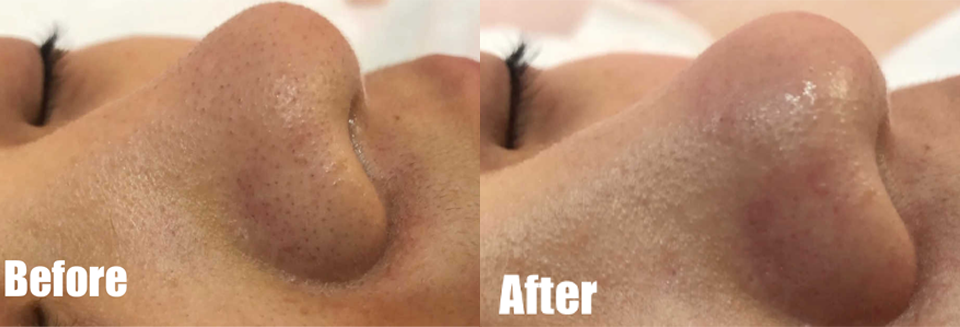 After Treatment